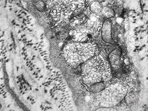 M, 3y. | lipofuscinosis M, 3y. | lipofuscinosis
